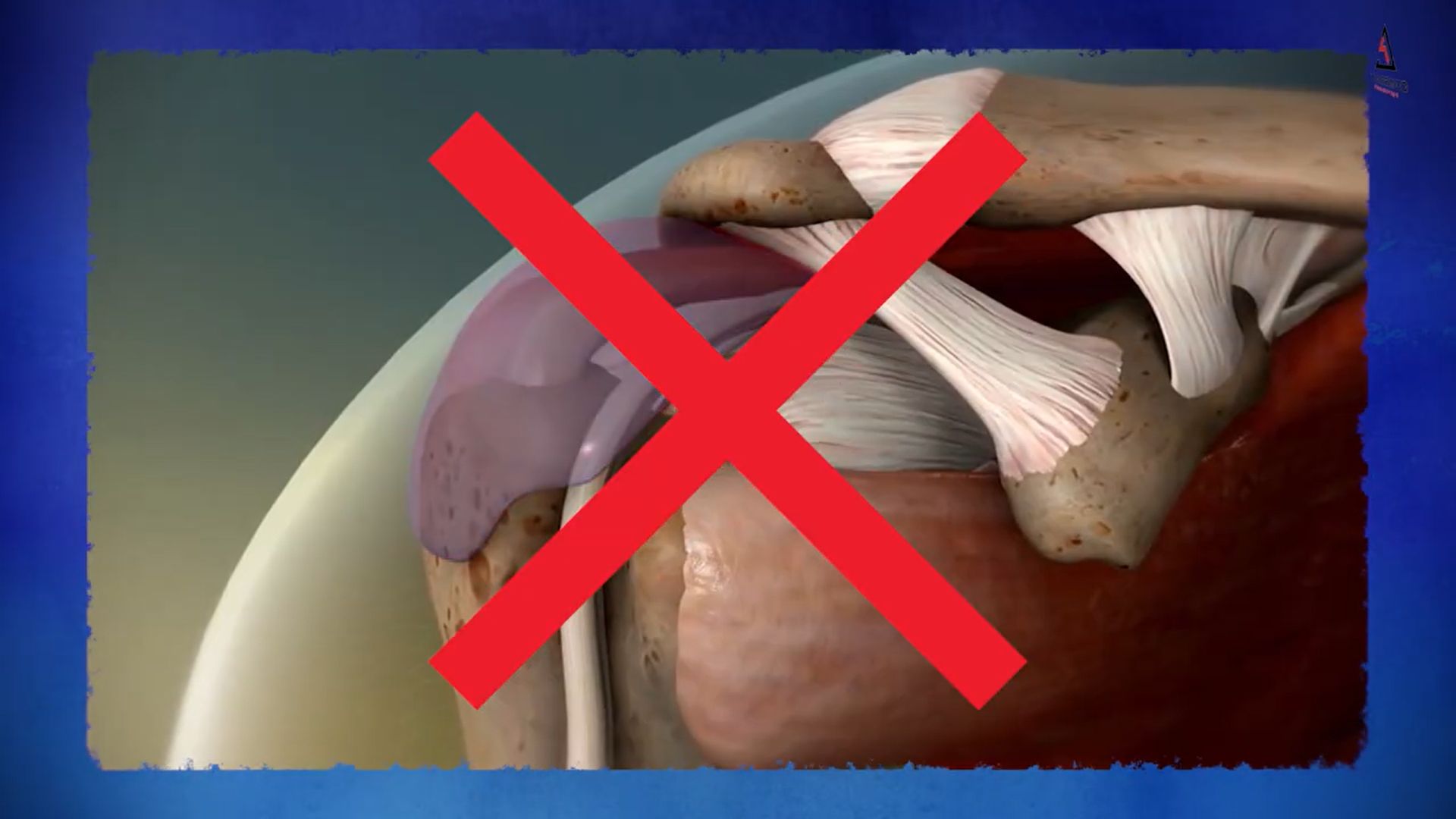 fast shoulder impingement relief